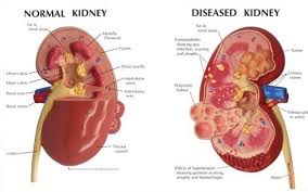 Management Of Chronic Renal Disease In Primary Care Kidney Failure Symptoms Kidney Failure Renal Failure