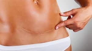 Pentru cezariana este necesara dovada maturitatii fetale si exista pentru aceasta mai multe tehnici. Cum Tratam Cicatricele Dupa Cezariana