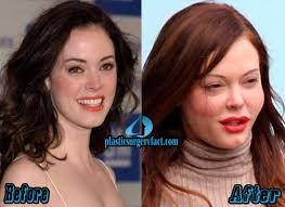 As indicated by rose mcgowan, she landed a nose position in 2007 to rectify a . Rose Mcgowan Plastic Surgery Before And After Photos Plastic Surgery Facts