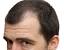 Female Frontal Hair Loss