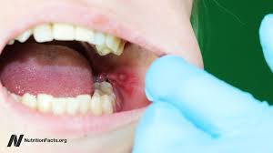 Image result for Canker sores symptoms roof of the mouth