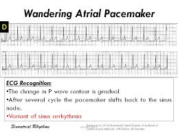 Pacemakers, ecg's of them, problems. Wandering Atrial Pacemaker Ecg Diagnosis The Grepmed