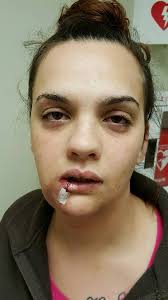 Warning: Do not click link without reading! Hey all, I had the unique  privilege of obtaining a video of my very own AVM repair surgery. I am  posting the link below for