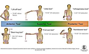 Image result for Lift-Off Subscapularis Test