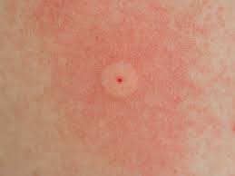 epingle sur piqure insecte