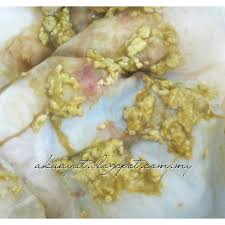 Ada juga pesakit yang sering membeli ubat di farmasi dengan mempunyai persepsi berak berdarah adalah hanya buasir dan itu adalah normal. Pengalaman Bayi Berak Berdarah Akuayut