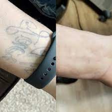 Number 1 place to go to in minot if you are needing a tattoo. Laser Tattoo Removal Altaire Clinic