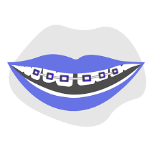 My front teeth came in very gapped out. Can Braces Correct Teeth Spacing In Adults Smile Prep