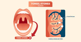 A noninvasive treatment used to minimize or remove tonsil crypts where tonsil stones can become lodged Tonsil Stones Ent Doctor Shares 4 Ways To Get Rid Of These Stinky Masses
