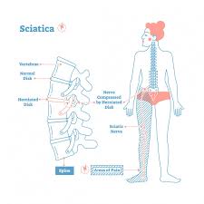 The upper portion, or the cranial cavity , houses the brain , and the lower portion, or vertebral canal houses the spinal cord. Sciatica Symptoms