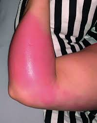 Image result for erysipel photos)