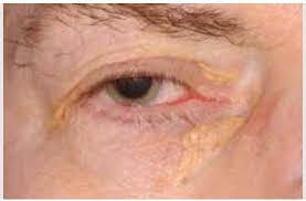 Image result for xanthelasma of eyelid