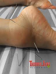 Tapi tahukah anda apa punca sebenar buku lali dan siku menjadi hitam? Terseliuh Di Buku Lali Syifa Acupuncture Treatment Facebook