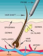 Electrolysis hair removal can be helpful for almost any region of the skin and all types of hair. Get The Best Palm Beach Permanent Hair Removal At This Electrolysis Clinic
