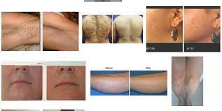 Please call 020 7998 1604 for more information. Dr Me Ping Gel Permanent Hair Removal Bikini Leg Arms Website 1 Http Www Siobay Com Products Php Ref World 20no 1 20permanent 20hair 20removal 20products Website 2 Http Permanenthairremover Wordpress Com Permanent Hair Removal In London Laser