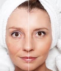 Pickelmale entfernen mit dem dermaroller. Microneedling Gegen Aknenarben Pickel Und Mitesser