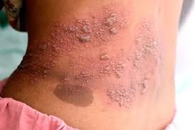 Image result for shingles