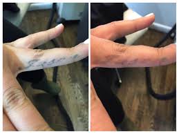 How many sessions to remove tattoo. Receiving Hired Soar Laser Hair Removal Fingers Certificateohsas18001 Com