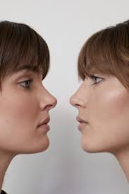 Actress han gain is a perfect example of an asian woman who looks like she has a button nose—but actually has. Nose Job Los Angeles The Mecca