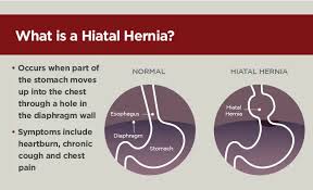 Image result for stomach hernia symptoms