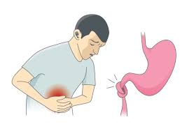 Maladies du colon, vous trouverez des informations pratiques et fiables sur maladies du colon le colon irritable ou syndrome de l'intestin irritable survient souvent après une infection intestinale, c'est. Le Quotidien Du Patient