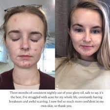 Hundreds of reviews and before/afters don't lie. This one product has  changed the skincare game, using only miracle ingredients from nature 🌿 ​  ​What's your Glory Oil story? 🌟 https://ecotan.com.au/products/glory-oil