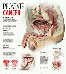 Research shows that around 70 percent of men over seventy have at least some cancerous cells in their prostate; Prostate Cancer Steemit