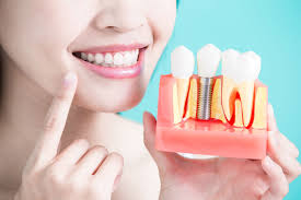 We did not find results for: Ini Harga Pasang Gigi Palsu Yang Kamu Butuhkan Audy Dental