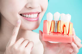 Gigi adalah bagian tubuh yang identik pada diri manusia, sehingga sangat mempengaruhi penampilan setiap orang. Ini Harga Pasang Gigi Palsu Yang Kamu Butuhkan Audy Dental
