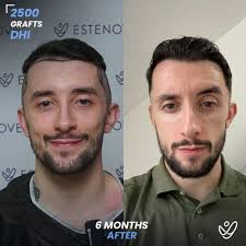 Hair Transplant Turkey Reviews