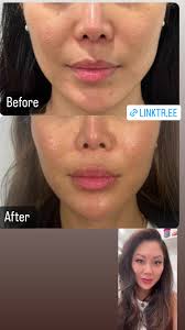 If you’re interested to help with revitalizing your skin, we recommend a  vampire facial and sculptra to help build your own collagen and elastin!