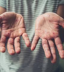 This is called the incubation period. 11 Home Remedies For Hand Foot And Mouth Disease