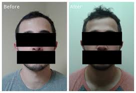 I recommend choosing your favorite two or three ways to stimulate hair growth from the list below and focusing on them. Case Study Alopecia Hair Loss In 30 Year Old Male Healing With Zen