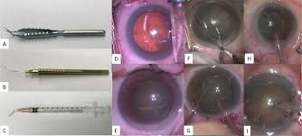 Image result for Cataract Extraction