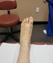 Significant foot pain that limits their everyday activities, including walking and wearing reasonable shoes. Getting Bunion Surgery
