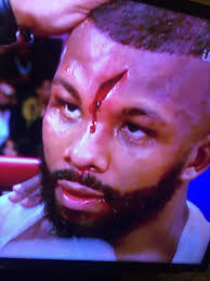Badou jack and marcus browne almost get into it during weigh in face off! Michael Benson On Twitter Badou Jack S Horror Cut Suffered After A Headbutt In His Defeat To Marcus Browne