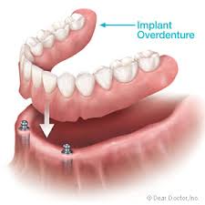 For most people, new dentures should fit well and with a bit of practice will stay in place without moving. Implant Supported Dentures A Better Fit With Excessive Bone Loss