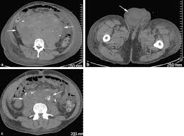 Cancer can spread to any part of your lungs. The Role Of Imaging In Staging And Monitoring Testicular Cancer Sciencedirect