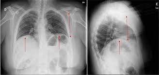Shrinking Lung Detected On Computed Tomography Pictorial Essay Of The Main Findings Of The Image