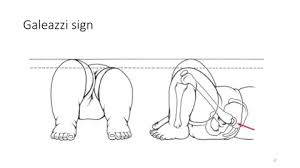 Image result for Galeazzi Sign