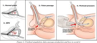 Image result for Urethral Catheterization