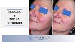 ☑️La toxina botulínica en pocas unidades y con varias infiltraciones se ha  postulado como una nueva opción de tratamiento para los casos más rebeldes  de rosácea que no se pueden solventar con
