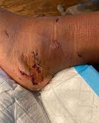 Under many circumstances, a gunshot wound to the and or foot, or even one that grazes the abdomen or face aren't likely to be fatal. Megan Thee Stallion Posts Gunshot Wound Photo To Instagram