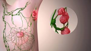 Hva gjør lymfeknutene og hvorfor hovner de opp? Lymfom Lymfekreft Symptomer Diagnose Og Behandling Lommelegen