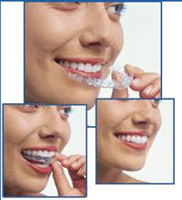 There are also a range of orthodontic treatments which are possible to have which do not have invisible braces. Invisalign From Newman Springs Dental Care In Lincroft