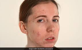 Frisuren 2019 frauen mittellang stufig frisuren mittellang stufig fransig frisur frisuren schulterlang frisuren festliche frisuren schulterlange haare. 10 Rose Water Benefits From Antioxidants To Anti Aging Ndtv Food