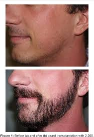 This hair will have a similar texture and growth tendencies as natural facial hair, which produces a realistic, natural result. Pdf Facial Hair Restoration Effective Techniques For Beard And Eyebrow Restoration Semantic Scholar