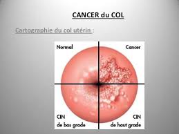Il est principalement causé par certains types de les saignements vaginaux ne sont pas nécessairement le signe d'un cancer du col de l'utérus. Cancer Du Col De L Uterus Symptomes Et Diagnostic