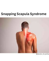 Image result for Snapping Scapula