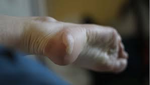 Comment faire partir une ampoule. Comment Soigner Une Ampoule 5 Astuces Simples Et Rapides